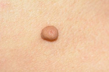 Cilt etiketi veya acrochondon veya yumuşak Fibrom