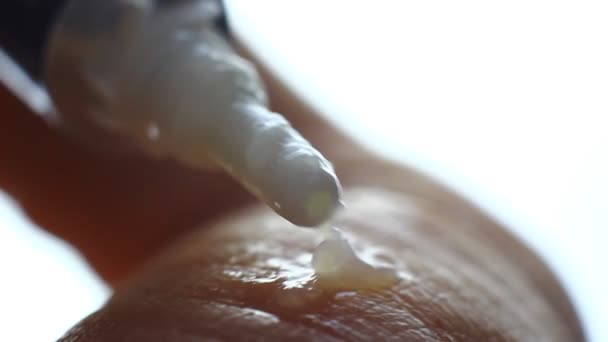 Εφαρμόζοντας Πάρα Πολύ Ιατρική Αλοιφή Ένα Χέρι Παλάμης Ξηρό Δέρμα — Αρχείο Βίντεο