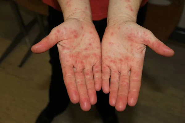 Male hands with rash. Patient with viral disease. Close Up of Painful rash, red spots blisters on the skin. Human palm with Health problem. Banner, copy space. Allergy, dermatitis