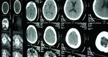 4 k Doktorlar kafatası beyin röntgen filmi analysis.health tıbbi hastane için çalışma.