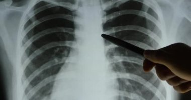4 k doktorlar kaburgaların, göğüs kafesi eklemleri röntgen filmi analysis.medical sağlık için ho çalışma