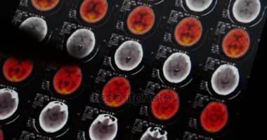 4 k doktorlar kafa pet-BT kafatası beyin tarama X-ray film analizi hastalığı için eğitimi.