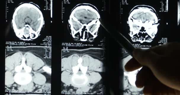 4k Os médicos estudam o filme de raio-X do cérebro do crânio para o hospital médico analysis.health . — Vídeo de Stock