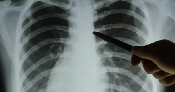 4k medici studiano costole, articolazioni della costola-gabbia pellicola a raggi X per l'analizzazione. salute medica ho — Video Stock