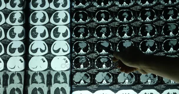 Les médecins 4k étudient le film radiographique du cerveau du crâne pour l'analyse.hôpital médical de santé . — Video