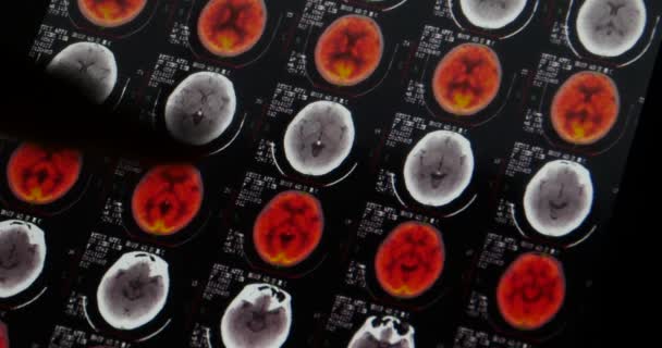 4 k lékaři studují hlava lebka, pet-ct vyšetření mozku X-ray film pro analýzu nemoc. — Stock video