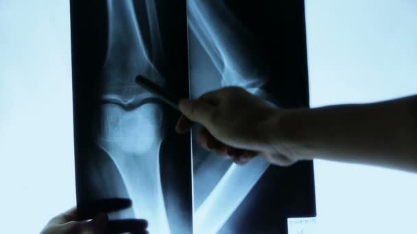 Medici studiano braccio, gamba e palmo delle articolazioni pellicola a raggi X per l'analisi . — Video Stock