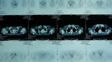 insan subklavyen pet-ct tarama, lenf düğümleri X-ışını, kanser metastaz.
