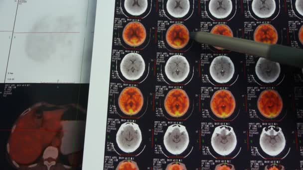 Врач изучает цвет головы ПЭТ, рентген мозга черепа . — стоковое видео