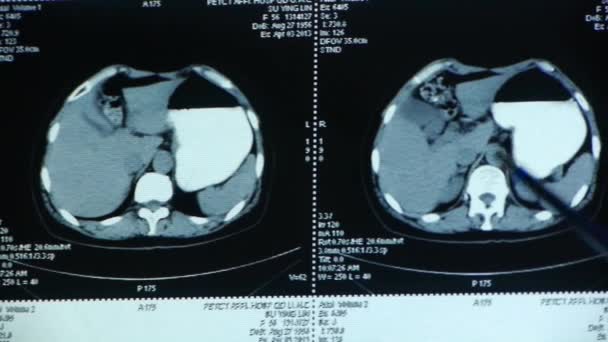 Läkare studie gallblåsan pet-ct scan, mänskliga organ röntgen radiografi. — Stockvideo