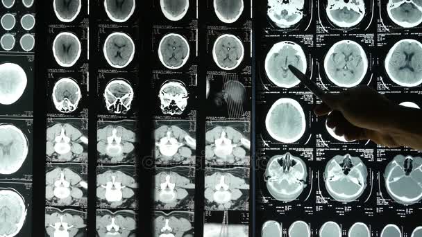 4k Os médicos estudam o filme de raio-X do cérebro do crânio para o hospital médico analysis.health . — Vídeo de Stock