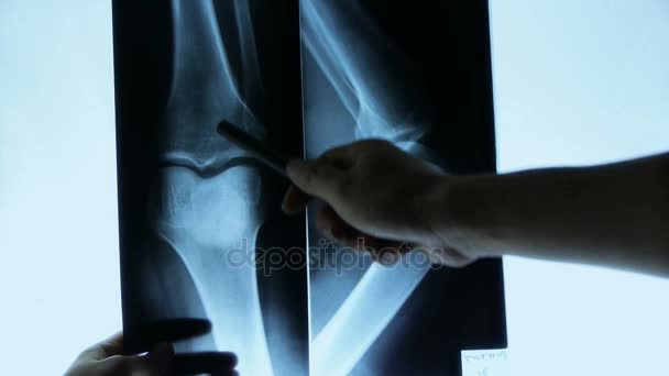 Doctors study arm,leg & palm joints X-ray film for analysis. — Stock Video