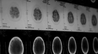 Çin-Eyl 08, 2017: kafa pet ct taraması, kafatası beyin X-ray taşıma.