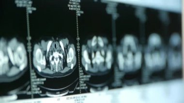 insan subklavyen pet-ct tarama, lenf düğümleri X-ışını, kanser metastaz.