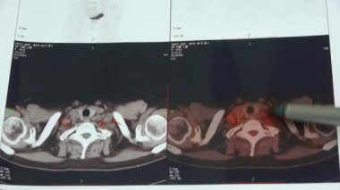 Doktor çalışma renkli köprücük pet-ct tarama, lenf düğümleri X-ışını, kanser metastaz.