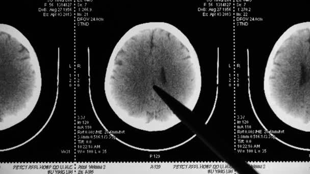 China-Sep 08, 2017:doctor studie hoofd pet/ct-scan p.a. de ziekte, schedel, hersenen X-ray. — Stockvideo