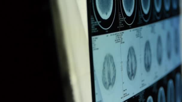 Läkare studie huvud pet/ct scan för analys av sjukdomen, skalle hjärna röntgen. — Stockvideo