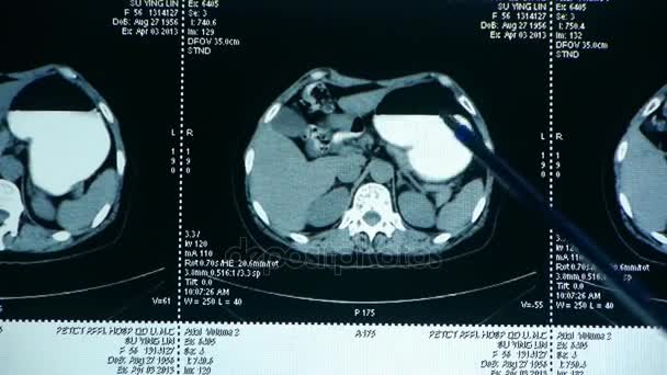 China-Sep 08,2017: estudo médico Gallbladder pet-ct scan, radiografia de raios X de órgão humano . — Vídeo de Stock