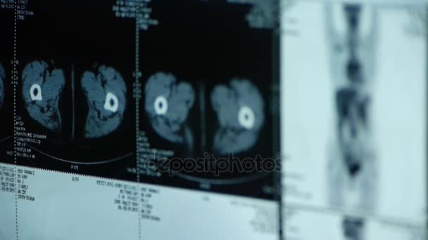 Κίνα-Σεπ 08, 2017:human orage & σπινθηρογράφημα οστών pet-ct, X-ακτίνα, μετάσταση του καρκίνου. — Αρχείο Βίντεο