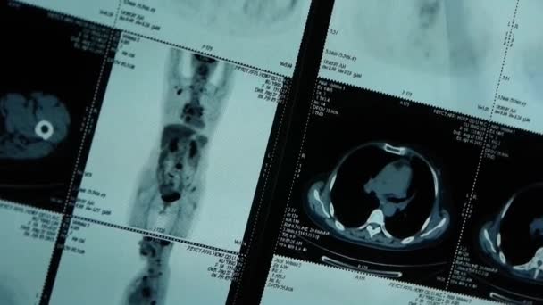 中国 9 月 08 日 2017: 人間オラージュ ペット ct スキャン、X 線医療がん転移を移動. — ストック動画
