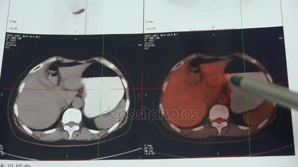 Dokter studie kleur maag pet / ct scan, menselijke orgel X-ray radiografie. — Stockvideo