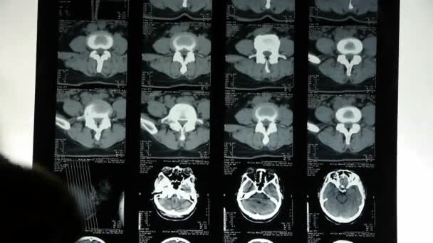 Doctors study skull brain X-ray film for analysis.cerebellum,brainstem. — Stock Video