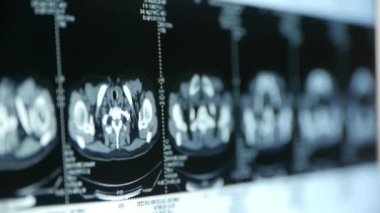 Çin-Eyl 08, 2017:human hastalığının pet-ct taraması, lenf düğümleri X-ışını, kanser metastaz.