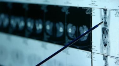 12 Ekim, 2017:doctor insan orage çalışma ve pet-ct taraması, X-ışını, kanser metastaz kemik.