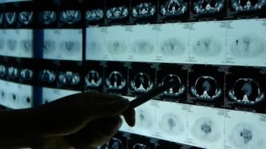 Chian-Ekim 12, 2017:doctor çalışma insan orage ve kemik pet-ct taraması, X-ışını, kanser metastaz.