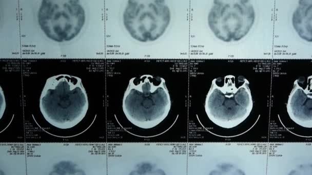 Oct 16,2017:moving head pet cT scan,skull brain X-ray. — Stock Video