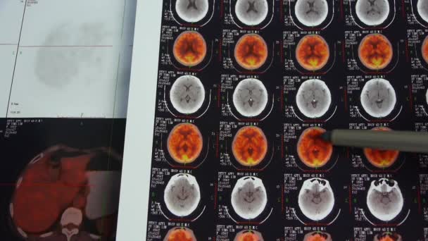 Врач изучает цвет головы ПЭТ, рентген мозга черепа . — стоковое видео