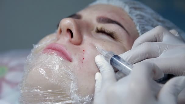 W salonie piękności lekarz kosmetolog wstrzykuje się kwas hialuronowy do twarzy. Procedura biorevitalization — Wideo stockowe
