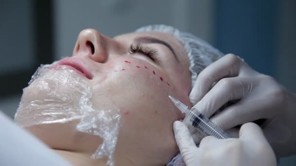 A kozmetikus tesz egy ügyfél injekció a hialuronsav bőrszövet visszaállítására. Az eljárás biorevitalization — Stock videók