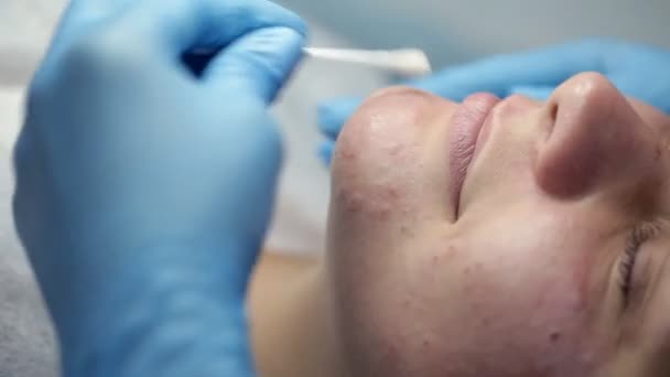 Tratamento facial após um procedimento mecânico de limpeza facial — Vídeo de Stock