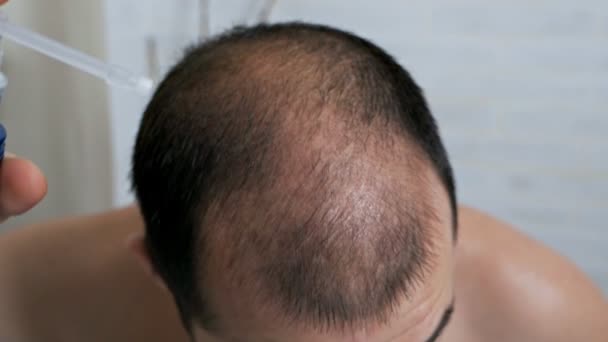 Медленное движение лысеющий мужчина перед зеркалом заботится о своих волосах, использует средства для роста волос в случае выпадения волос . — стоковое видео