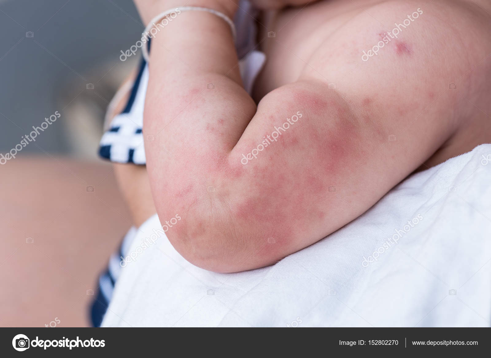 Baby Skin Texture Suffering Severe Urticaria Nettle Rash Stock Photo By C Tinglee1631