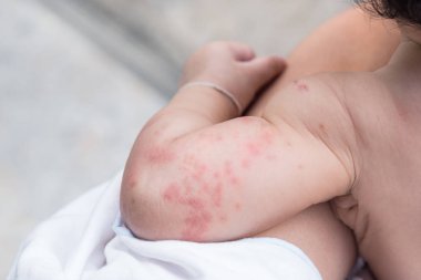 Baby skin texture suffering severe urticaria, nettle rash. clipart