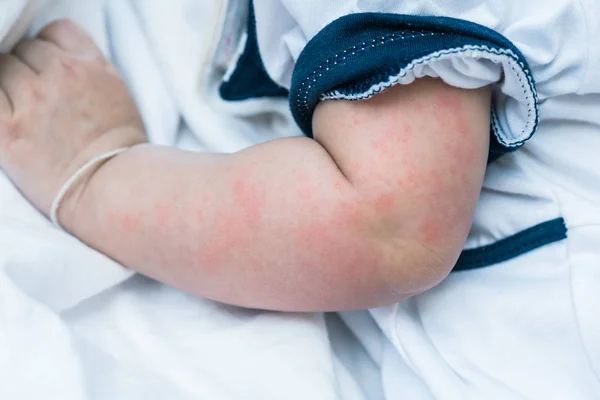 Textura de la piel del bebé que sufre urticaria severa, erupción de ortiga . — Foto de Stock