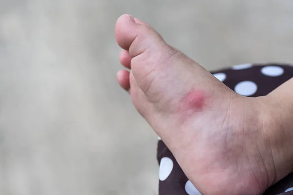 Allergiás kiütés bőr a baba jobb láb. — Stock Fotó