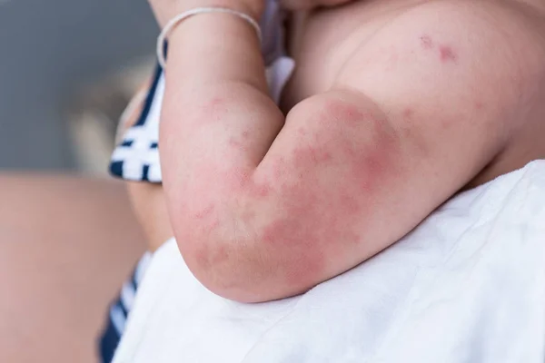 Baby huidtextuur lijden van ernstige urticaria, huiduitslag nettle. — Stockfoto