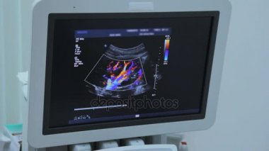 Renkli kan damarları ve arterler böbrek ultrason için izleyicisi'nde