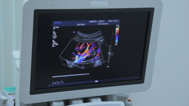 Gekleurde bloedvaten en bloedvaten in de nier in monitor voor echografie — Stockvideo