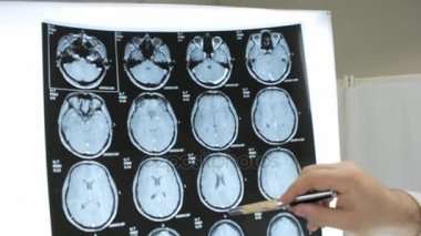 Doktor insan beyni, kanser tanısında Mr görüntülerini inceliyor