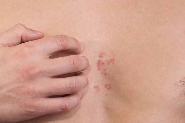 dermatitis on the chest of a man