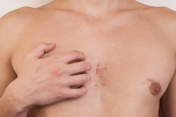 dermatitis on the chest of a man