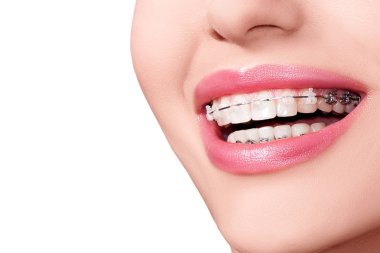 Ceramic and Metal Braces on Teeth. Dental Braces Smile. Orthodontic Treatment. Closeup Smiling Face with Braces. Isolated on White Background