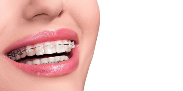 Tirantes Dientes Ortodoncia Sonríe Tratamiento Ortodóncico Cara Sonriente Primer Plano — Foto de Stock