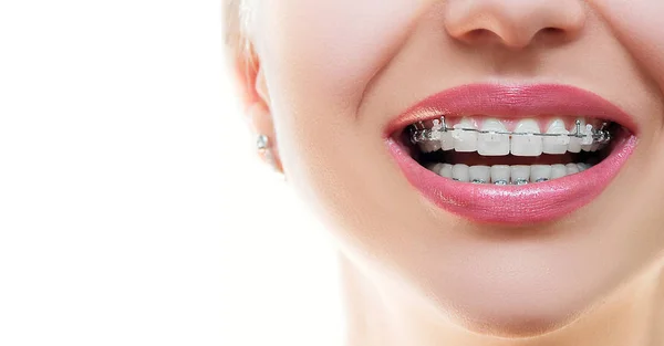 Close Open Mouth Ceramic Metal Braces Beautiful Teeth Broad Smile — Stock Photo, Image