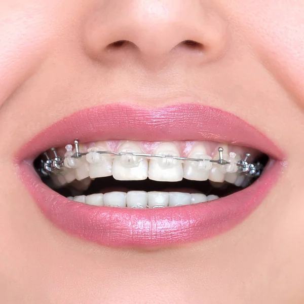 Orthodontic Treatment. Dental Braces. — Stock Photo, Image