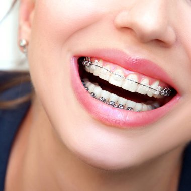 Close up the open mouth with Ceramic and Metal Braces on beautiful Teeth